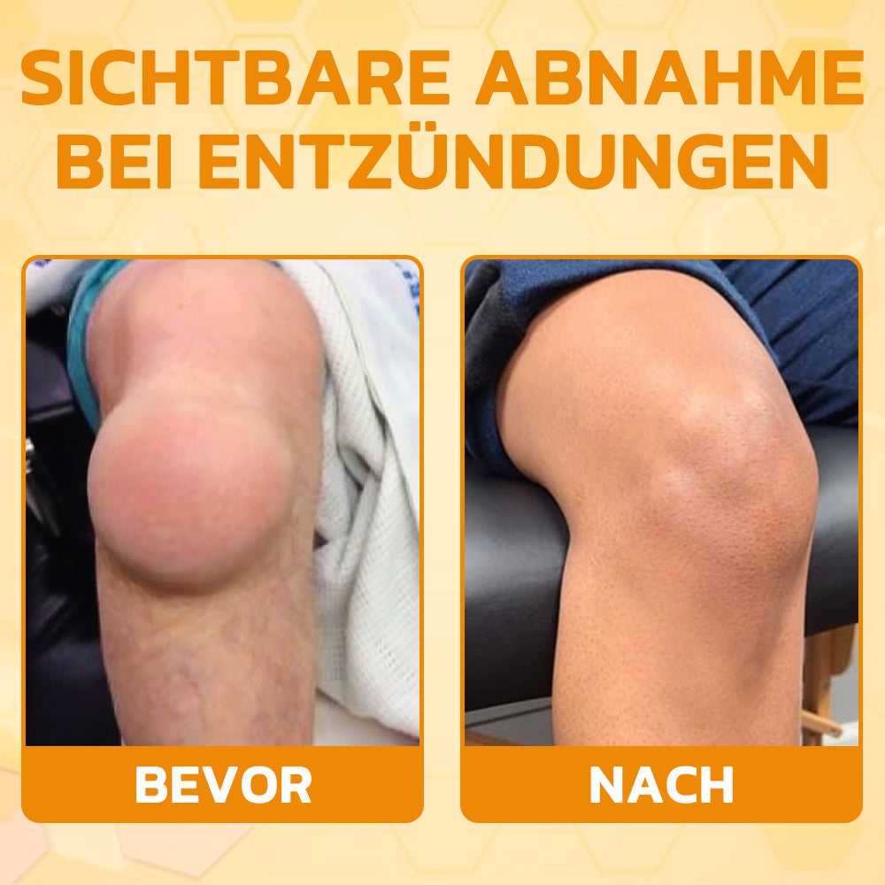 Aetheris™ Bienengift Sofort-Ultra-Stärke Schmerztherapie-Creme🇩🇪DGOU Genehmigt