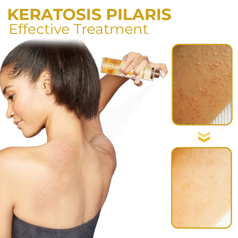 Furzero™ Cleartosis Bienengift Keratosis Pilaris Spray