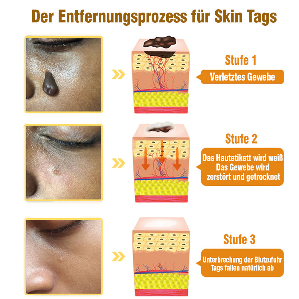 flysmus™ Creme zur Entfernung von Bienengift-Tags 🌿 Hergestellt in Deutschland 🇩🇪 DDG Recommend