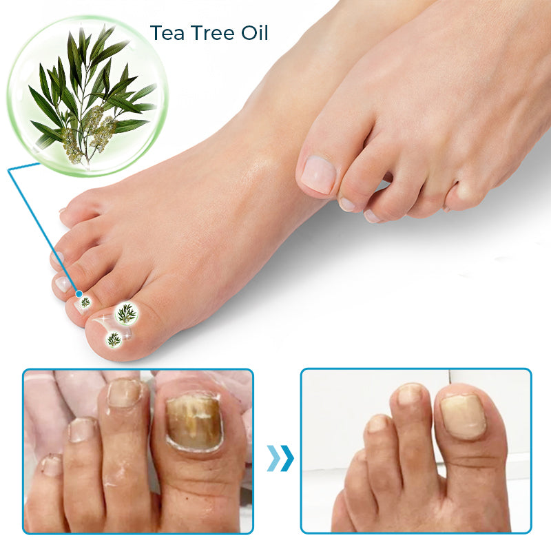 Furzero™ Bienengift Nagelpilz-Behandlungslösung💅