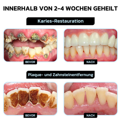 🎖️Furzero™ Focussmile Bienengiftbehandlung Pulver zum Einnehmen (🇩🇪 BZÄK Zugelassen)