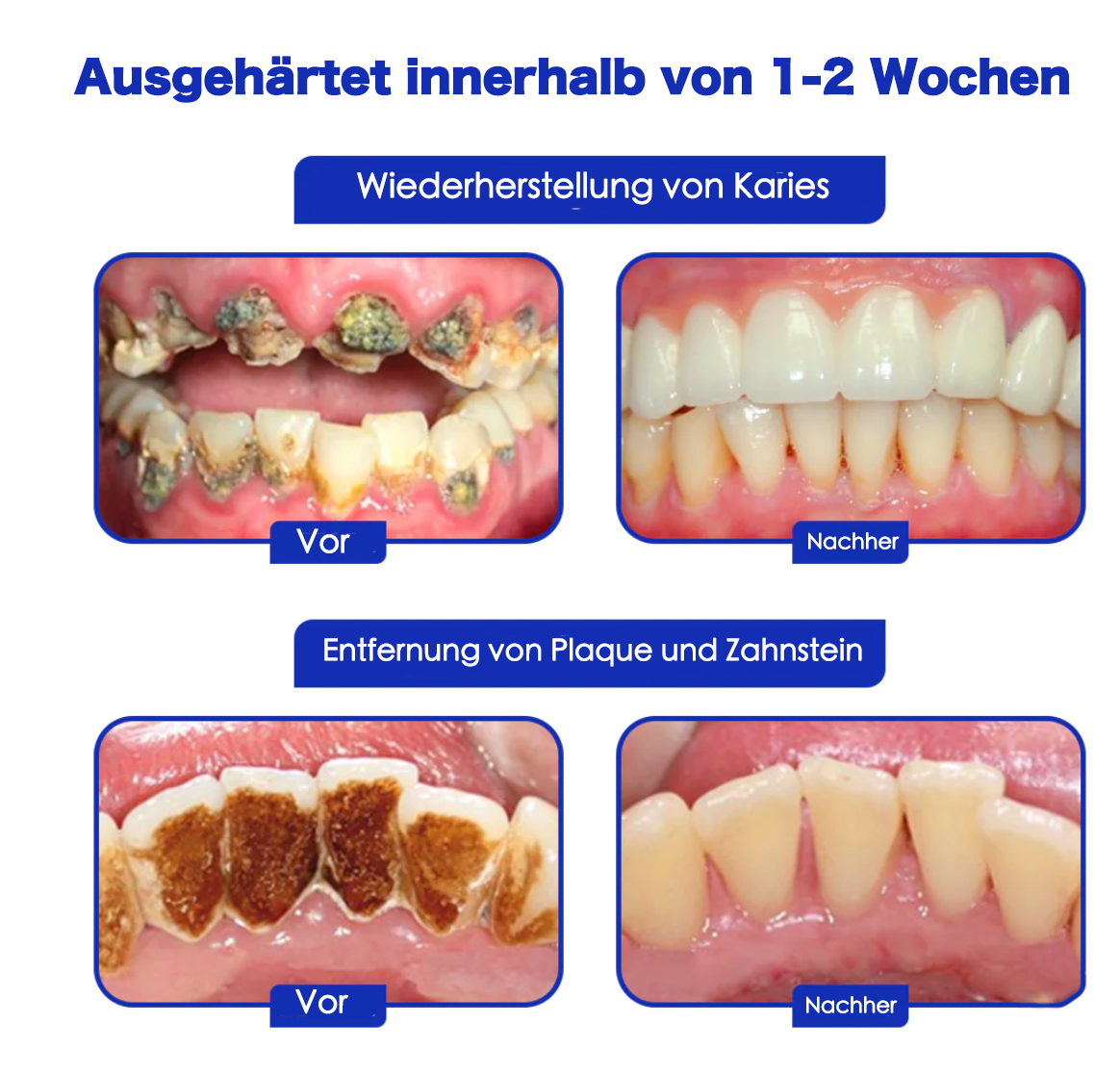 💥 Furzero™ Focussmile Bienengift Behandlung Pulver zum Einnehmen 🦷 (BZÄK empfohlen)