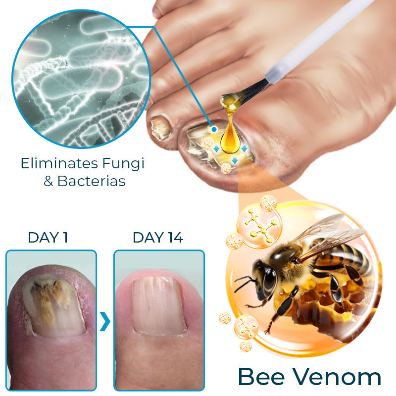 Furzero™ Bienengift Nagelpilz-Behandlungslösung💅